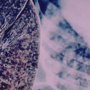 Tuberculosis - A Complex Health Threat
