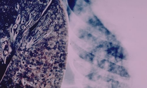 Tuberculosis - A Complex Health Threat
